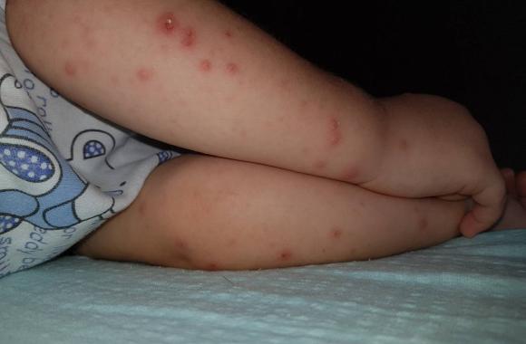 U Zvorniku povean broj dece sa simptomima temperature i osipa po tijelu |  Radio Osvit